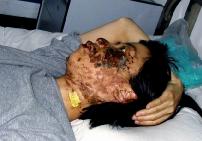 2004年5月7日，高蓉蓉遭受持续点击，脸上是电烧灼伤。照片是受伤10天后拍摄的。