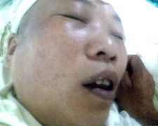 陈玉梅被恶警打昏后在医院的照片
