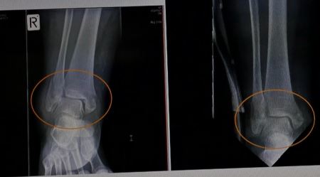 '图2：王久春女士2015年11月7日的踝关节X光片（左）与同年12月4日的X光片（右），对比可以看出，车祸3周后骨折处已有愈合趋势。'